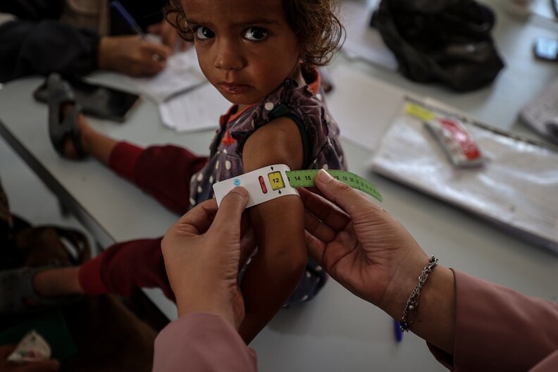 A child being screened for acute malnutrition using a color-coded tape around the upper arm.
