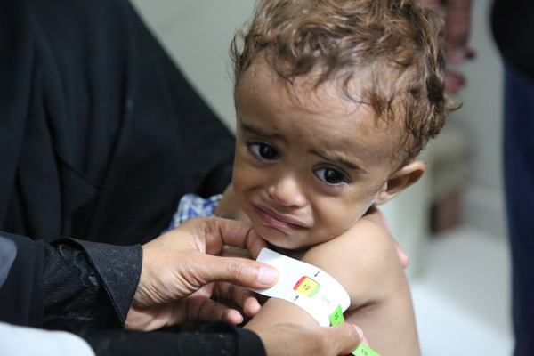 WFP Alarmed At Growing Rates Of Hunger And Malnutrition In War-Torn Yemen