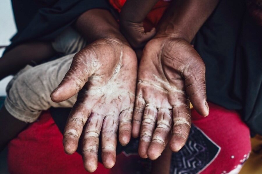 Farhia Ali shows her work-calloused hands to a visitor - the result of years of tilling the land. Photo: WFP/Sara Cuevas Gallardo