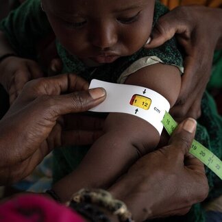 A child has mid-upper arm circumference measured for nutritional status