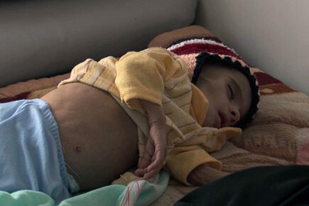 Yemen malnutrition (For the Media)